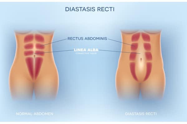 How Does Non-Surgical Treatment Help With Loose Skin, Weak Abdominal Muscles and Post-Pregnancy Changes Oadby?