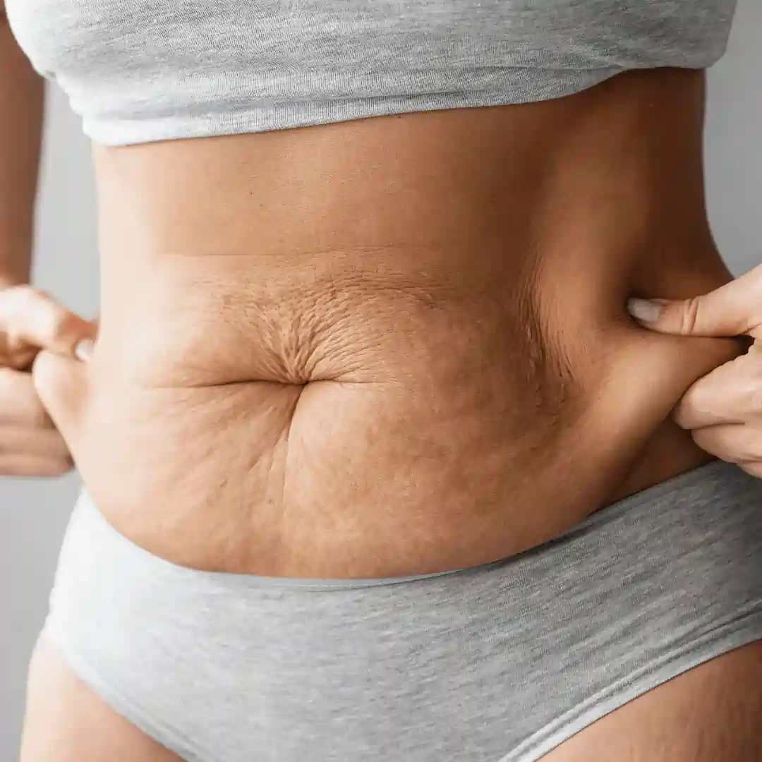 Is It Normal to Have Loose Skin After Pregnancy Oadby?